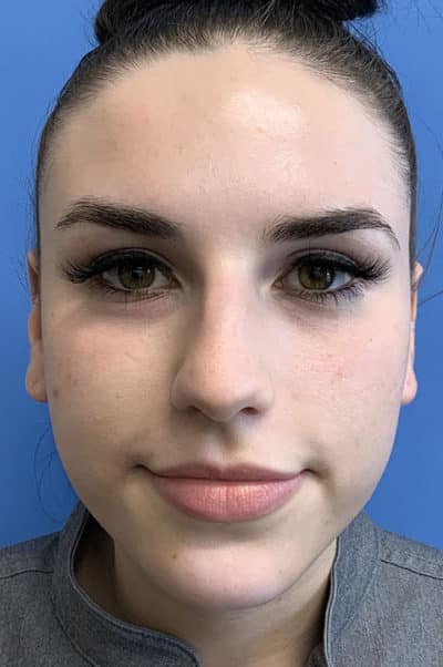 Rhinoplasty Case 476 Before Photo Rhinoplasty