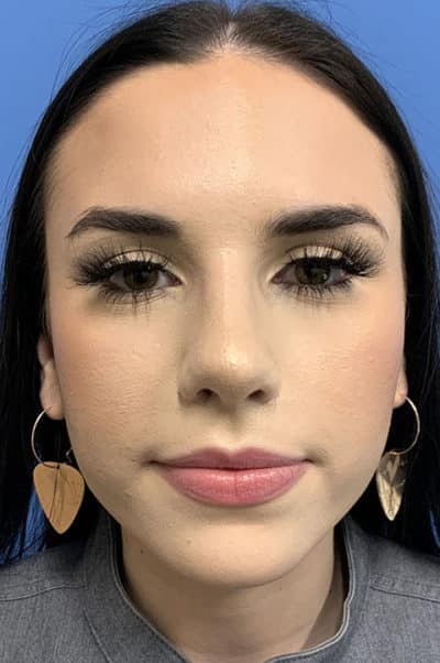 Rhinoplasty Case 476 After Photo Rhinoplasty
