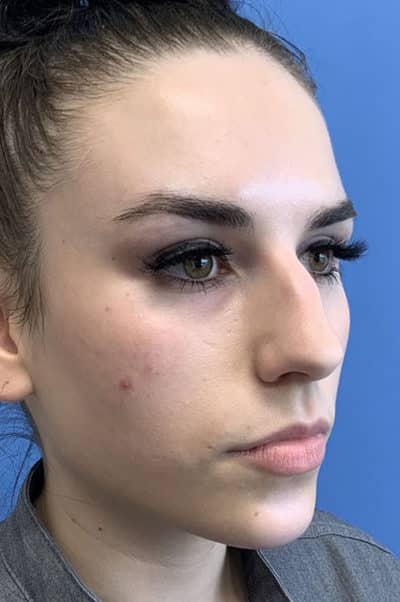 Rhinoplasty Case 476 Before Photo Rhinoplasty