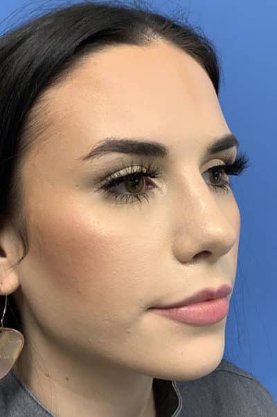 Rhinoplasty Case 476 After Photo Rhinoplasty