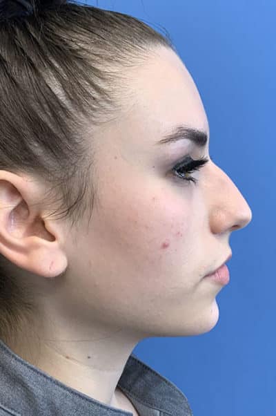 Rhinoplasty Case 476 Before Photo Rhinoplasty