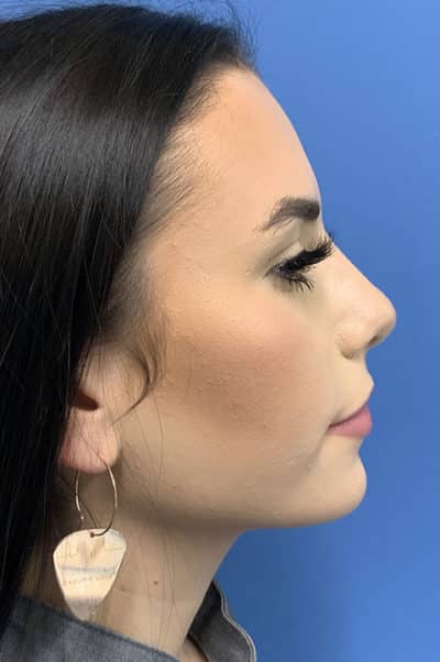 Rhinoplasty Case 476 After Photo Rhinoplasty