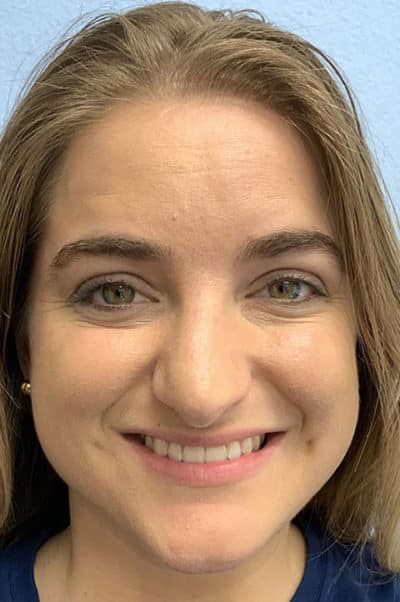Rhinoplasty Case 474 Before Photo Rhinoplasty