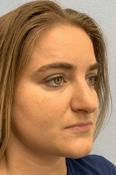 Rhinoplasty Case 474 Before Photo Rhinoplasty