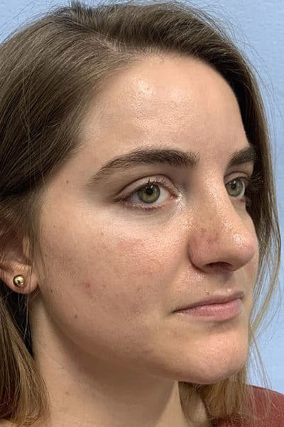 Rhinoplasty Case 474 After Photo Rhinoplasty