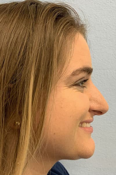 Rhinoplasty Case 474 Before Photo Rhinoplasty