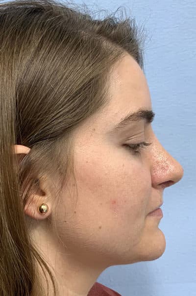 Rhinoplasty Case 474 After Photo Rhinoplasty