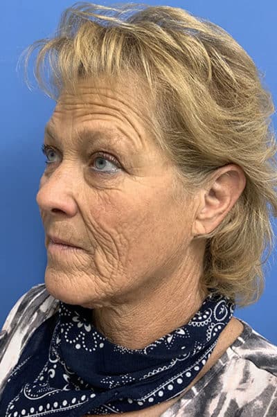 Face & Neck Lift Case 477 Before Photo Face & Neck Lift