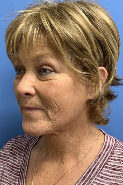 Face & Neck Lift Case 477 After Photo Face & Neck Lift