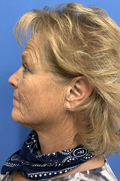 Face & Neck Lift Case 477 Before Photo Face & Neck Lift
