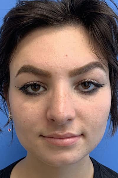 Rhinoplasty Case 475 After Photo Rhinoplasty