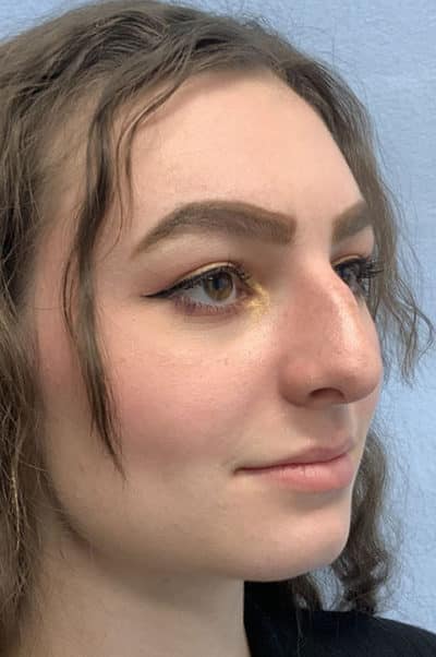 Rhinoplasty Case 475 Before Photo Rhinoplasty