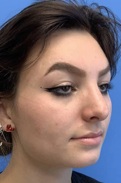 Rhinoplasty Case 475 After Photo Rhinoplasty