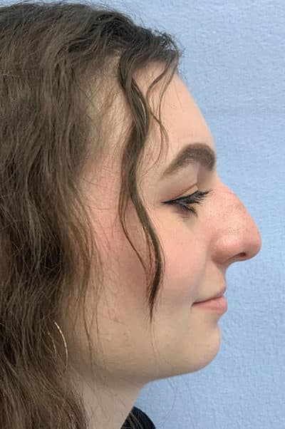 Rhinoplasty Case 475 Before Photo Rhinoplasty