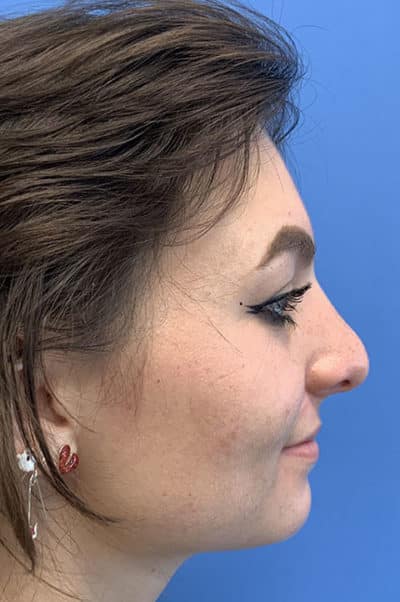 Rhinoplasty Case 475 After Photo Rhinoplasty