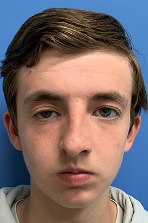 Rhinoplasty Case 621 Before Photo Rhinoplasty