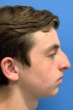 Rhinoplasty Case 621 Before Photo Rhinoplasty