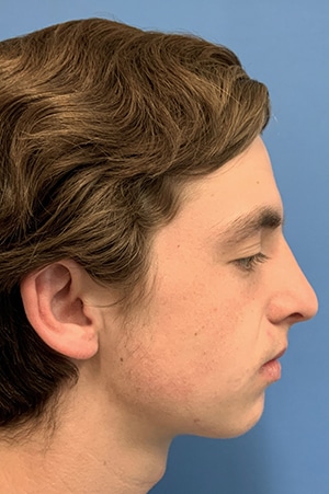 Rhinoplasty Case 621 After Photo Rhinoplasty