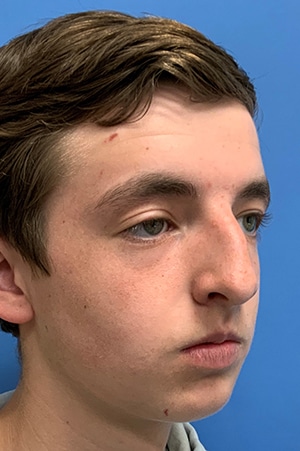 Rhinoplasty Case 621 Before Photo Rhinoplasty