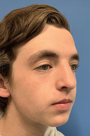 Rhinoplasty Case 621 After Photo Rhinoplasty
