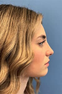 Rhinoplasty