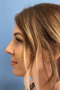 Rhinoplasty