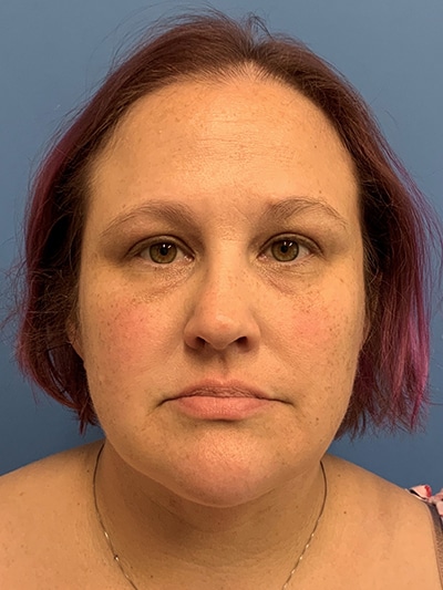 Face & Neck Lift Case 653 After Photo Face & Neck Lift