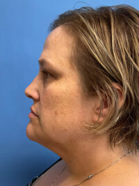 Face & Neck Lift