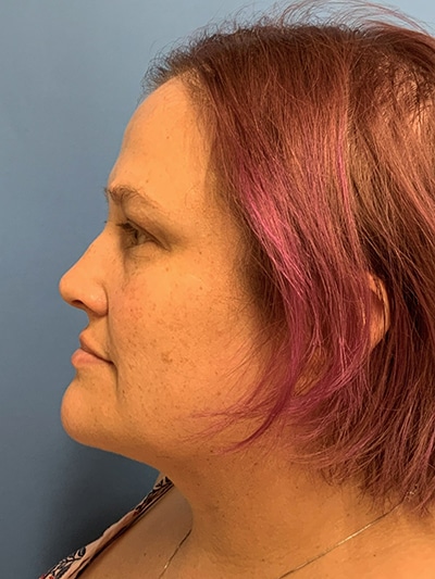 Face & Neck Lift Case 653 After Photo Face & Neck Lift