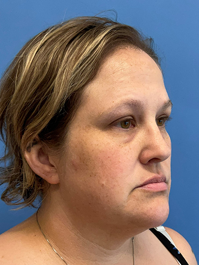 Face & Neck Lift Case 653 Before Photo Face & Neck Lift