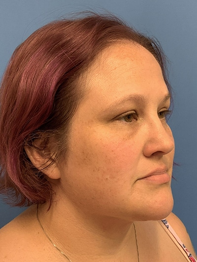 Face & Neck Lift Case 653 After Photo Face & Neck Lift