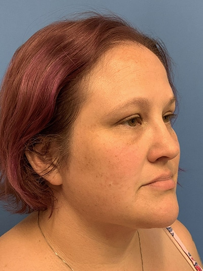 Face & Neck Lift