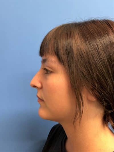 Rhinoplasty Case 675 Before Photo Rhinoplasty