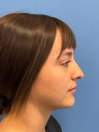 Rhinoplasty Case 675 Before Photo Rhinoplasty