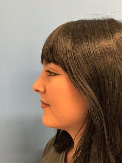 Rhinoplasty Case 675 After Photo Rhinoplasty