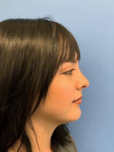 Rhinoplasty Case 675 After Photo Rhinoplasty