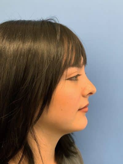 Rhinoplasty