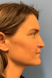 Rhinoplasty