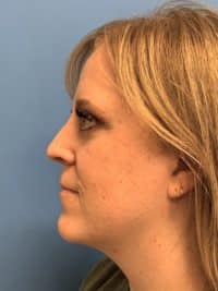 Rhinoplasty