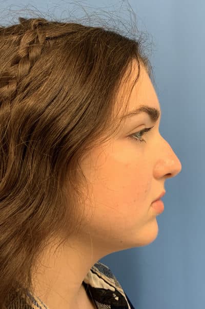 Rhinoplasty