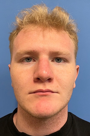 Rhinoplasty Case 721 After Photo Rhinoplasty