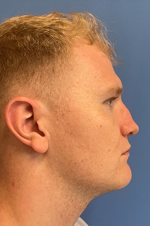 Rhinoplasty Case 721 Before Photo Rhinoplasty