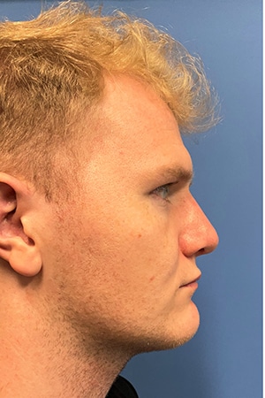 Rhinoplasty Case 721 After Photo Rhinoplasty
