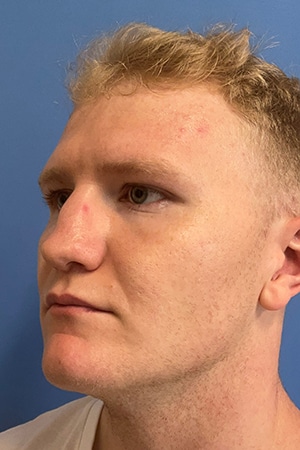 Rhinoplasty Case 721 Before Photo Rhinoplasty