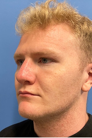 Rhinoplasty Case 721 After Photo Rhinoplasty