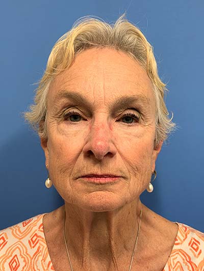 Face & Neck Lift Case 713 Before Photo Face & Neck Lift