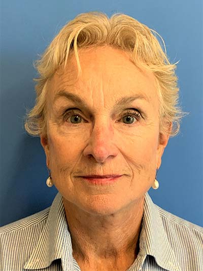 Face & Neck Lift Case 713 After Photo Face & Neck Lift