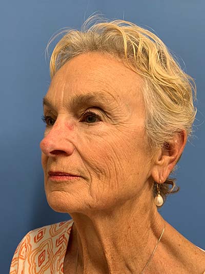 Face & Neck Lift Case 713 Before Photo Face & Neck Lift