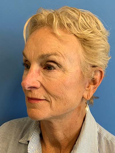 Face & Neck Lift Case 713 After Photo Face & Neck Lift