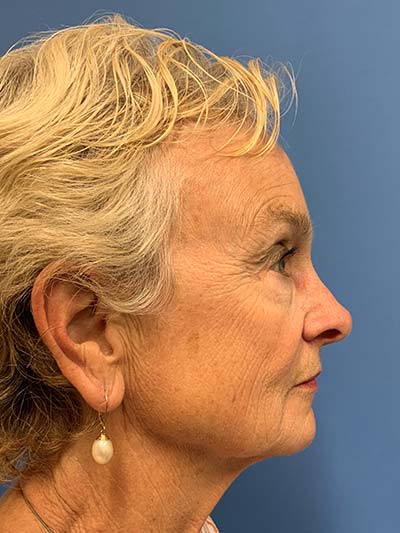 Face & Neck Lift Case 713 Before Photo Face & Neck Lift
